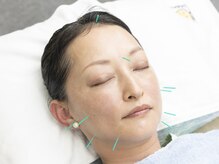 キュアハンズ 大森/美容鍼　表情筋調整