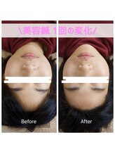 鍼灸院 はりのひと/美容鍼1回の変化！