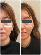 シュシュ(chouchou)/頬の幅がスッキリ♪