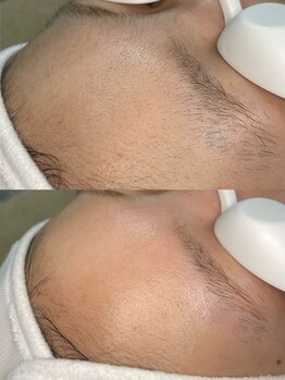 テンパ ビューティー(+10%beauty)/一撃タマゴ肌ワックス