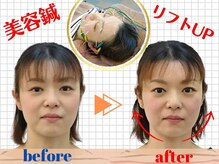 マッチ鍼灸整骨院の雰囲気（電気の美容鍼で美肌へ/小顔/頭蓋ヘッドスパ【円山・西１８丁目】）