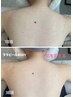 【背中ニキビケア】後ろ姿もキレイ♪ララピールBODY