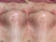 ヴィーヴ 京橋(vive)/【韓国式3D毛穴洗浄】