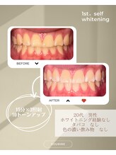 スリール(sourire)/ビフォーアフター