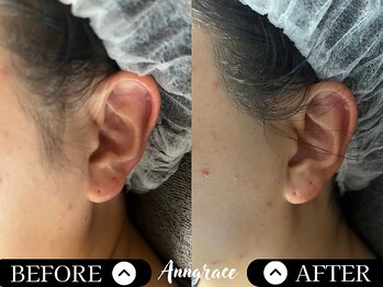 アングレイス(Anngrace)/【お顔脱毛もみ上】Before/After