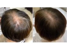 ピエリ ザ ビューティステイション 春日原店(Pierie THE BEAUTY STATION)/ヒト幹細胞スパ