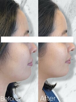 ルミライ(Lumirai)/頬の面積縮小!