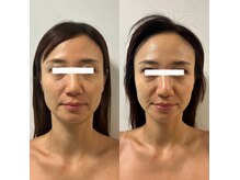 【たるみ/毛穴】中顔面短縮リフト★一回で5歳若見えたるみケア