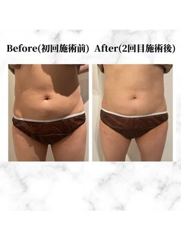 ザビューティー 麻布十番本店(The Beauty)/12Dリフトお腹美くびれ[リフト]