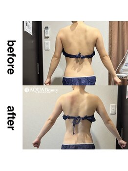 ビーエスアクアビューティー/背中＆二の腕シェイプ