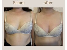 リネア(Linea)/【Before→After】