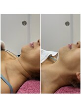 GRACETHOUSAND(グレイスサウザンド)/首のシワに/ハーブピーリング