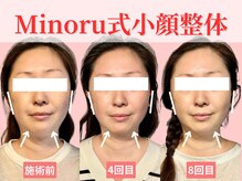 フレキシボディ(FlexiBody)/小顔施術ビフォーアフター #6