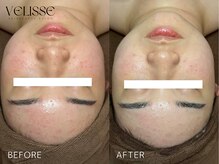 Velisse 表参道店【ヴェリス】《毛穴/肌質改善/ハーブピーリング/ニキビケア》/