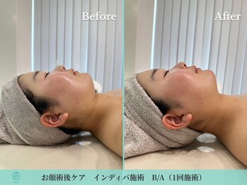 ノット(KNOT)の写真/【枚方唯一/施術後ケア】吸引・ダウンタイム後のお悩みに◎自身の体験×身体分析で早期の完成をサポート♪