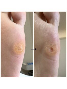 ネイルサロンアンドスクール ペルシャ(Persia)/硬めの魚の目も対応できます♪