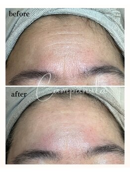 カンパニュラ(campanula)/リアボーテ・幹細胞フェイシャル