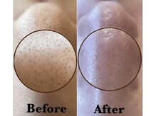 メリア(Mellia)/韓国式3D毛穴洗浄