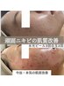 繰り返すニキビケア、赤ニキビケア最後の肌改善エステ¥7900→¥5000
