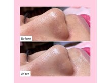 ホワイトラボ 梅田茶屋町(White labo)の雰囲気（毛穴洗浄しながら美容成分を補給するハイドロフェイシャル☆）