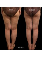 美骨(BIKOTSU)/脚の骨格ケア