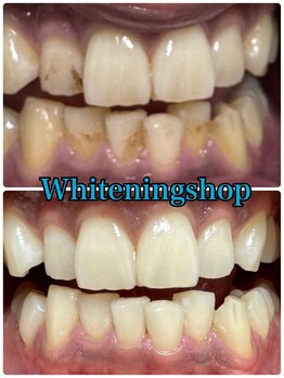 ホワイトニングショップ 山形店(Whiteningshop)/タバコ吸いながらでも大丈夫♪