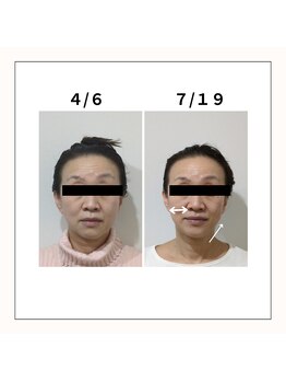 ミヤビ(miyabi)/小顔矯正