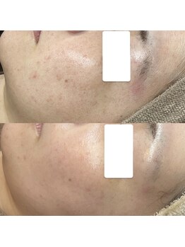 ベリスユイット(BELLIS HUIT)/【剥離なしハーブピーリング】