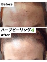 ルベル(Luvelle)/ハーブピーリング