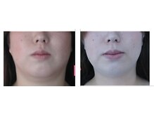 アイビューティーセンター/小顔リフト