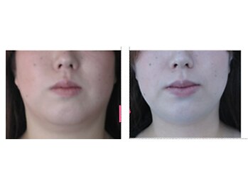 アイビューティーセンター/小顔リフト