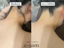 イーサム 高槻摂津富田店(e-sam)/丸ごと全身脱毛