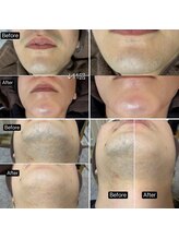 サマラボ 三軒茶屋(Sama Labo)/Before→After(顔脱毛)