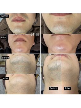 サマラボ 三軒茶屋(Sama Labo)/Before→After(顔脱毛)