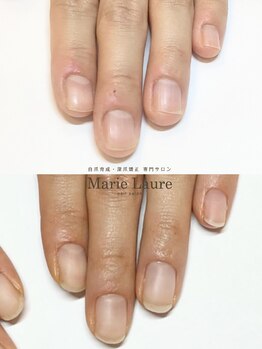 マリーロール 梅田店(Marie Laure)/自爪育成/深爪矯正/ネイルケア