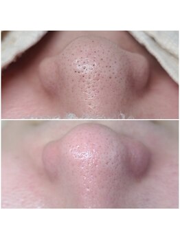 ウォーマル(warmaL)/毛穴エクストラクション