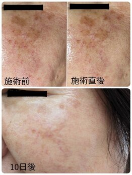 ブライトリー(Brightly)/美肌を諦めない