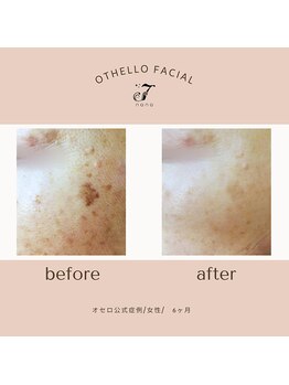 ナナ(nana)/◆before/after◆