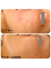 リボーテ(Re-Beaute)/エルモサハーブピーリング