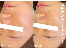 モノ(MONO)/【セルマントリートメント】