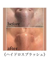 サロンドシェリ(salon de cheri)/ハイドロフェイシャル