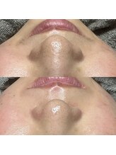 ラニー アンド ココネイル(LANIE&CocoNail)/お鼻のポツポツ解消　毛穴ケア！