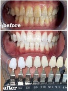 ミース 自由が丘店(MYS)/ビフォーアフターホワイトニング