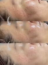 コア(Coeur)/lamination peeling