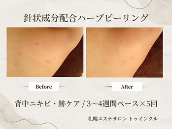 プライベートエステサロン トゥインクル/肩まわりの黒ずみ改善♪