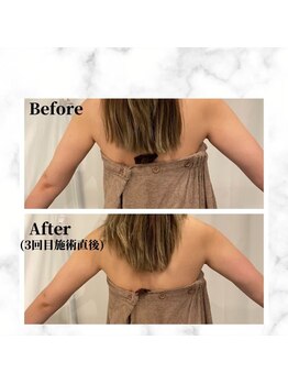 ザビューティー 麻布十番本店(The Beauty)/二の腕リフト打ち放題[リフト]