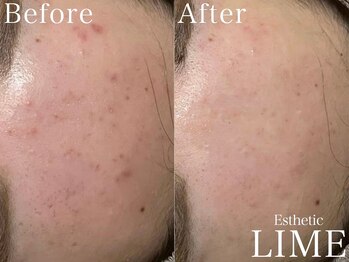 ライム 五反田(LIME)/ハーブピーリング|ニキビケア