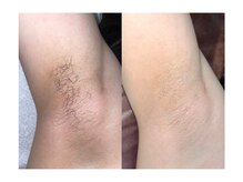 サロン ド スカイ(Salon de sky)/女性・脇