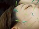 ルーロ サロン(LooLo salon)の写真/ー鍼灸×マシンのW施術ー今話題の小顔マシン”サーマルフラクショナル”取り扱い◎”違い”が分かる美容鍼!