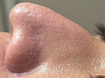 アマト 心斎橋店(Amato)の写真/毛穴汚れが浮き出る★Amato式毛穴洗浄が￥8800♪短期間で毛穴の黒ずみを薄くしたい方に♪部分毛穴ケアも◎